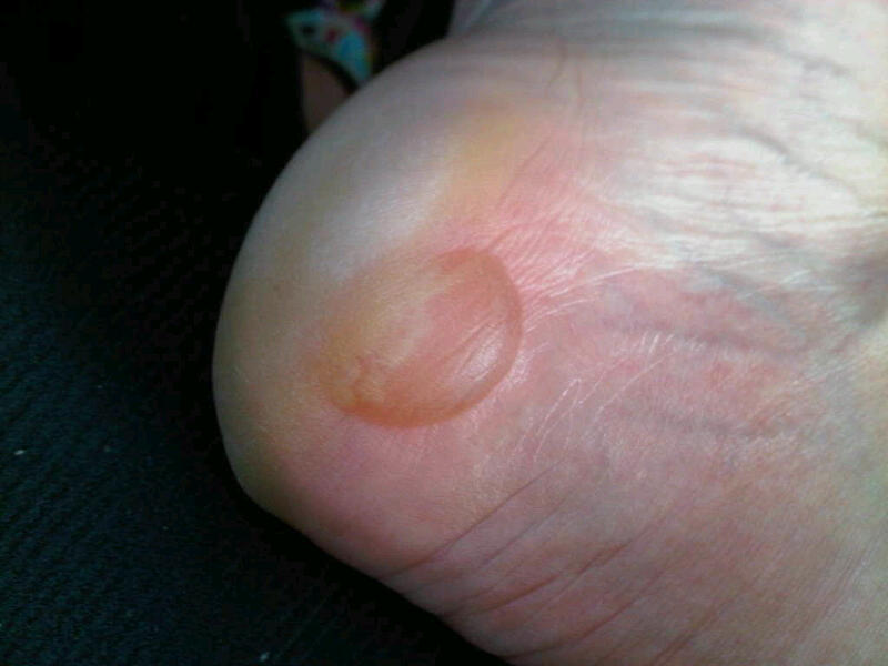 Blisters On Feet 108